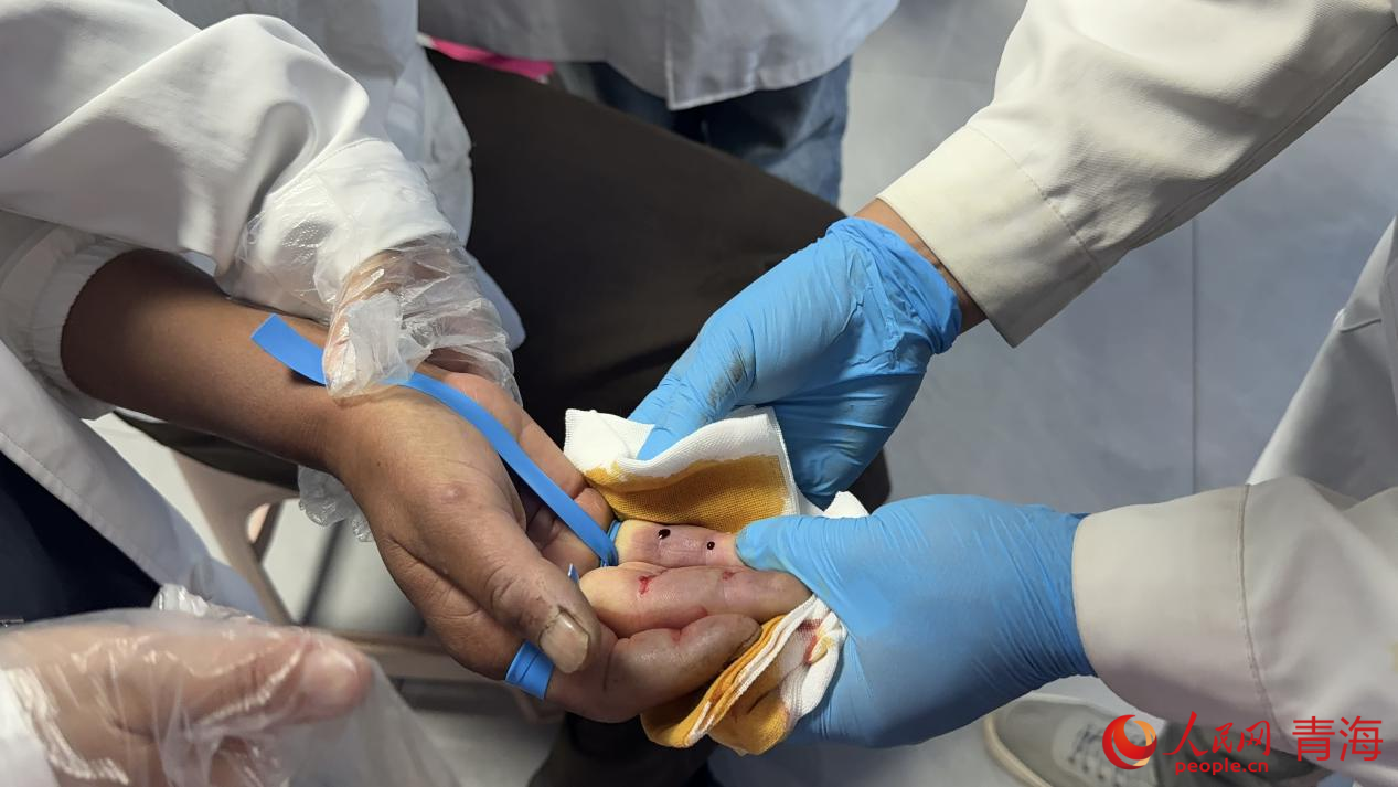 放血治療。人民網(wǎng) 況玉攝